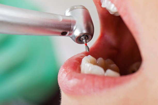 Best Emergency Dentist for Knocked-Out Tooth in Mpo, CA